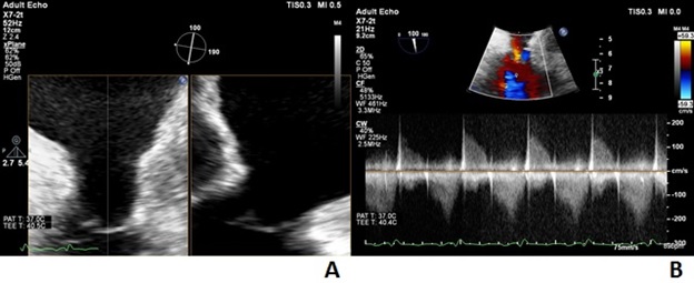 Balloon Valvuloplasty for Annular- and Leaflet-Level